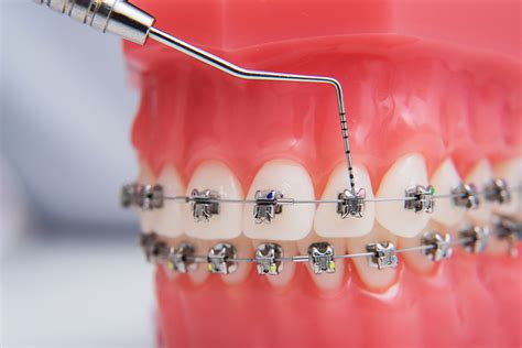 does all metal braces brackets need wire|metal braces replacement.